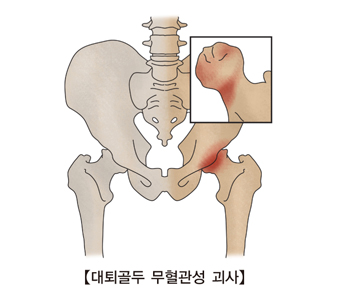 대퇴골두 무혈관성 괴사